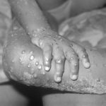 Signs of Monkeypox - Pix from Wikipedia
