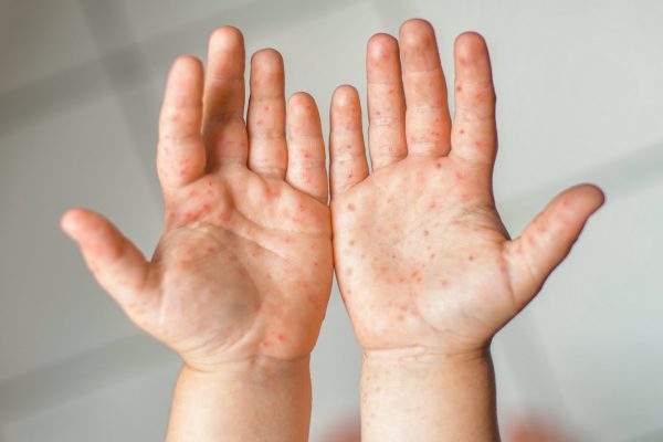 Hfmd Symptoms on a Child’s Hands, As Vietnam Rolls out Its First Hfmd Vaccine.